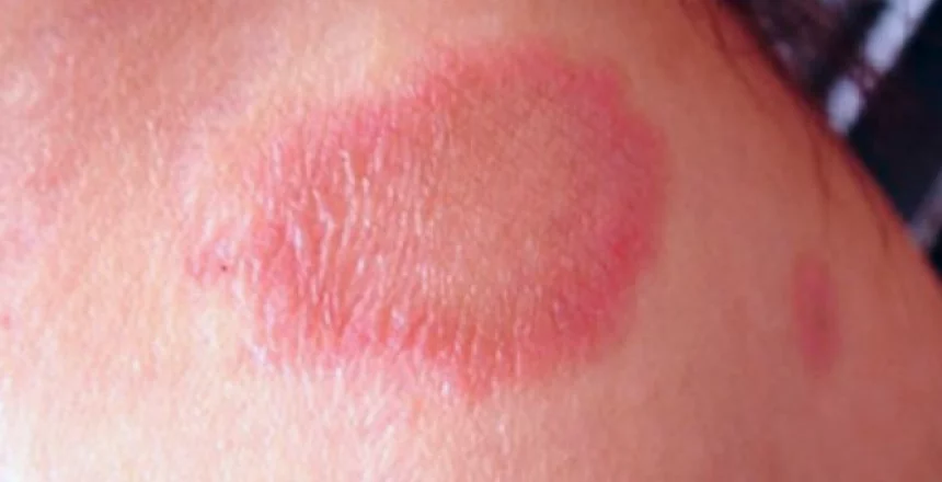 Vysivkopodibnyj Abo Kolorovyj Lyshaj